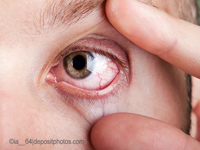 Trockene Augen Trockene Augen