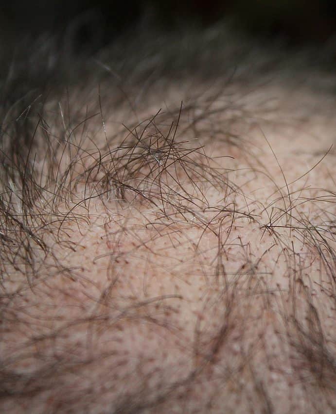 Erblich bedingten Haarausfall behandeln