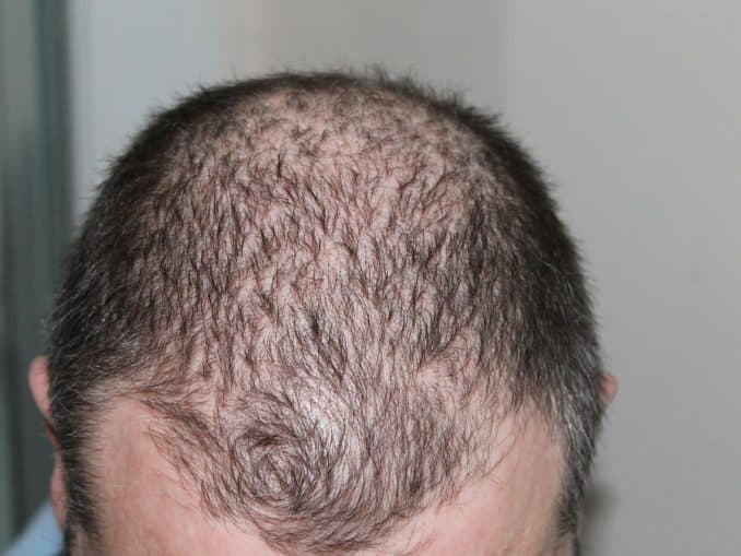 Erblich bedingter Haarausfall Erblich bedingter Haarausfall