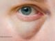 Rote geschwollene Augen
