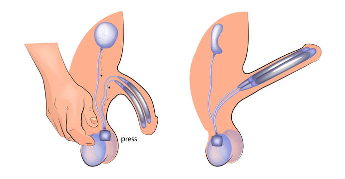 Schwellkörperprothese / Penisprothese
