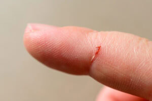 Kleine Schnittwunde am Finger