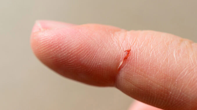 Kleine Schnittwunde am Finger Kleine Schnittwunde am Finger